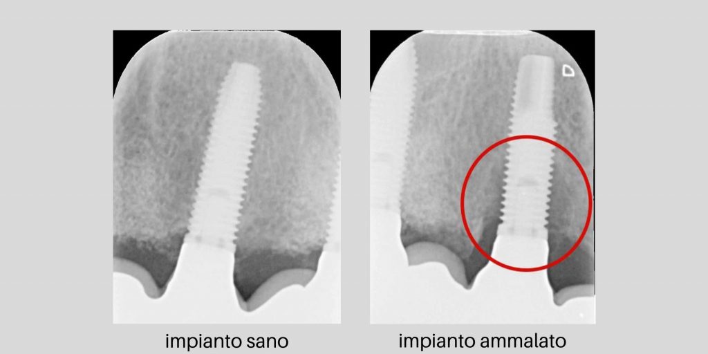 Radiografia endorale di un impianto dentale sano e con perimplantite