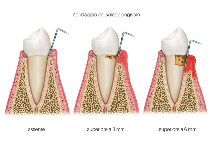 sondaggio parodontale