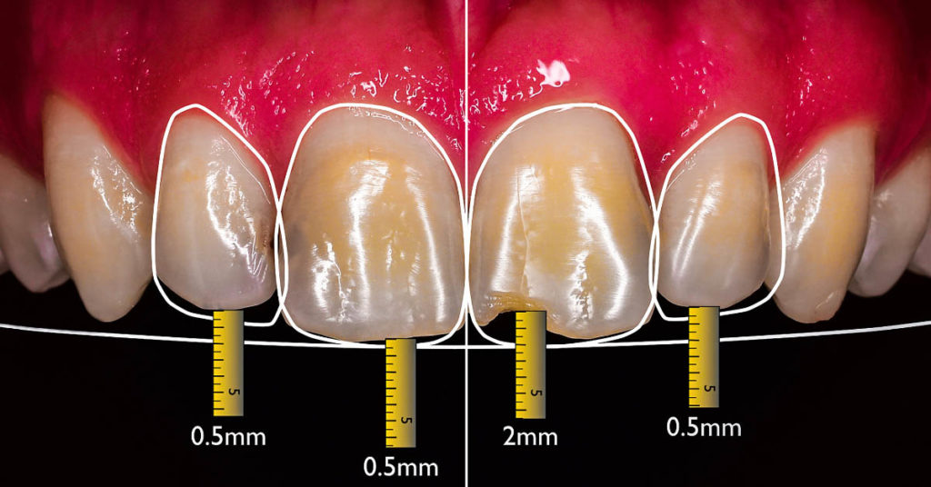 faccette dentali misurazioni