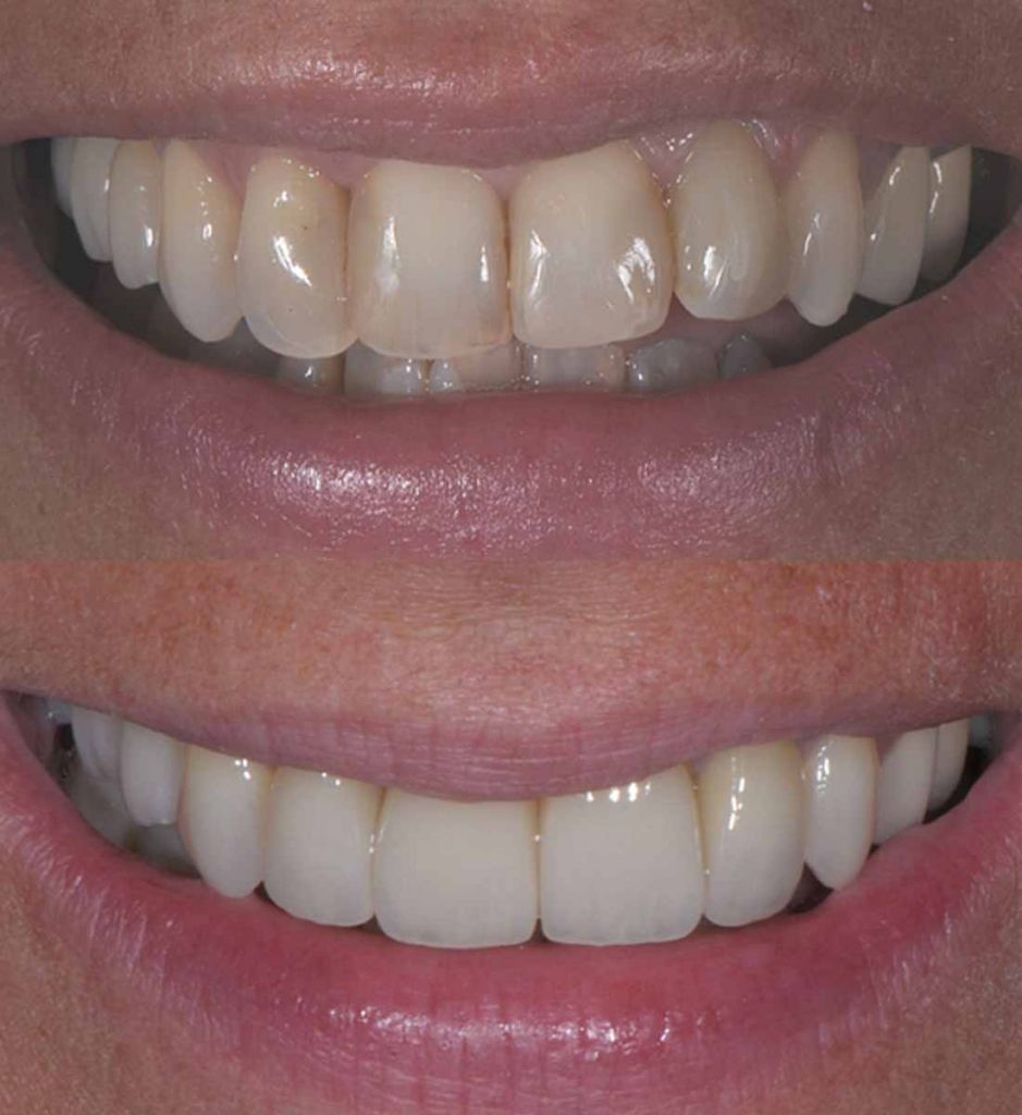 faccette dentali: sorriso prima e dopo