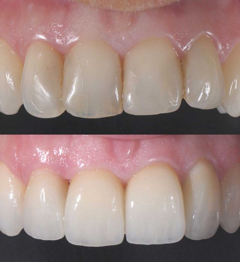 Colletti Dentali Prima E Dopo Faccette dentali - Clinica Villa