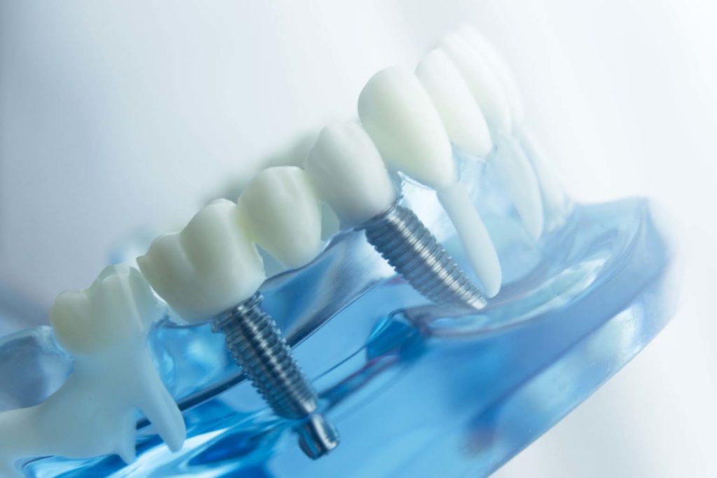 impianti dentali