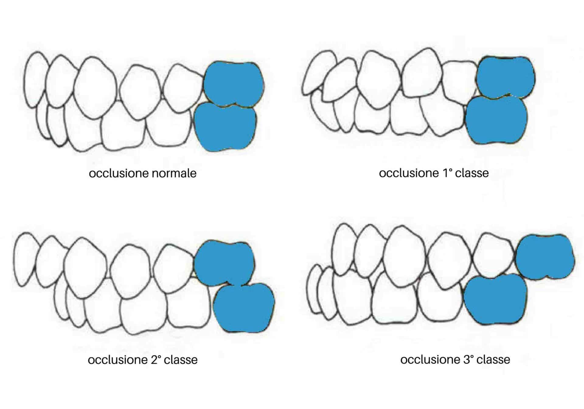 classificazione occlusione denti da latte