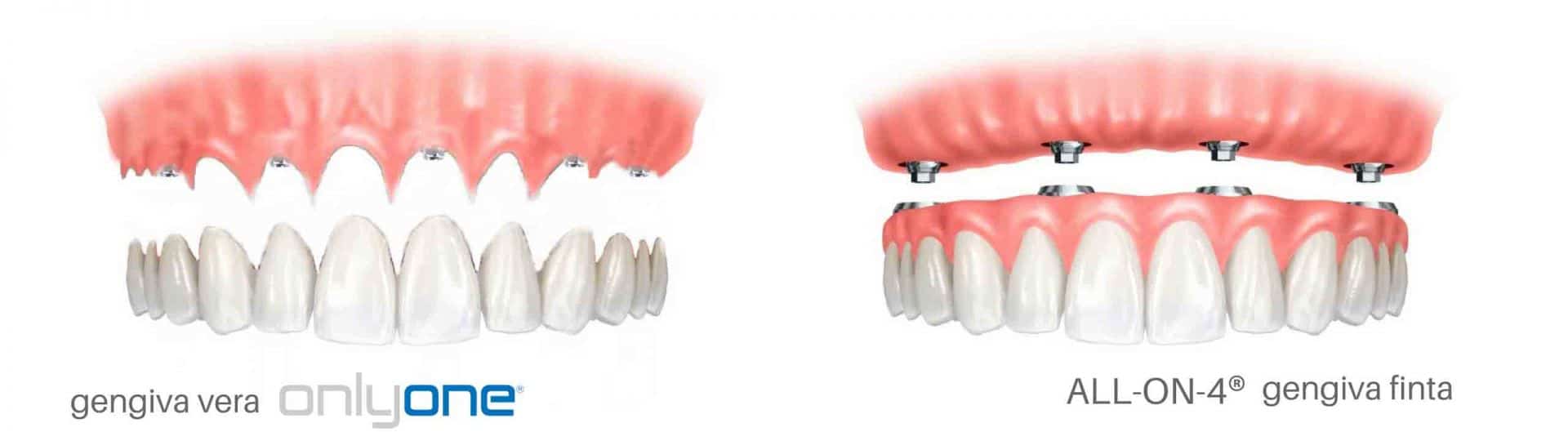 impianti dentali arcata superiore onlyone all on 4