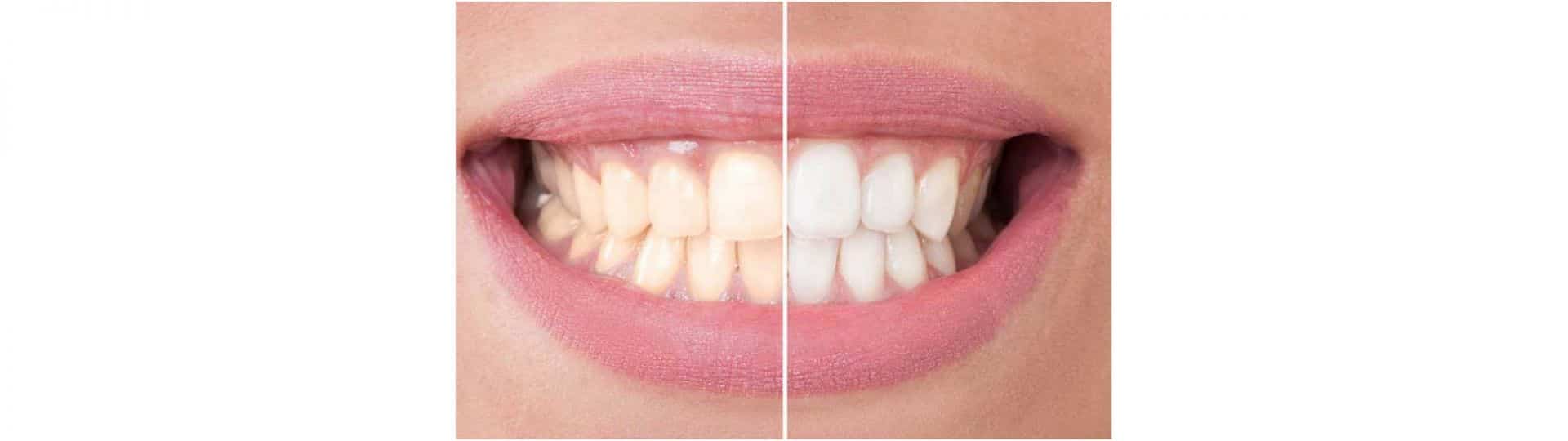 Sbiancamento dentale con laser prima e dopo