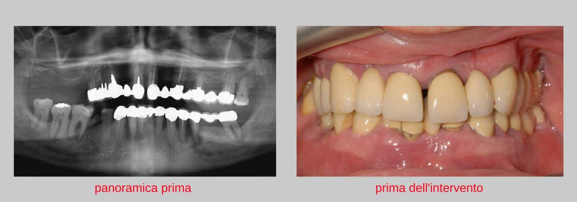 caso clinico implantologia estetica prima