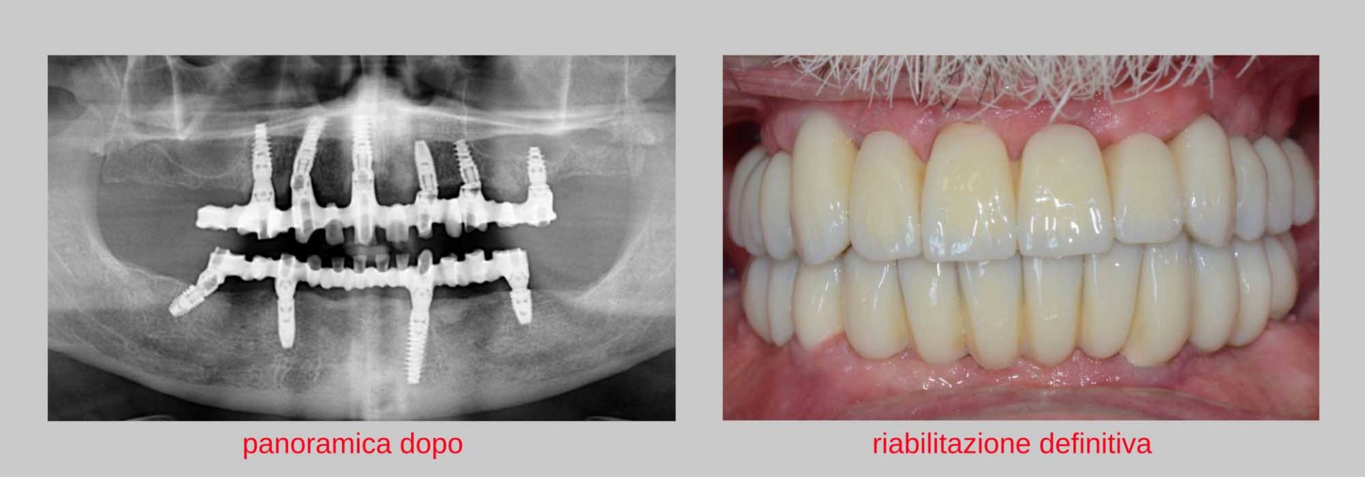 caso clinico implantologia estetica dopo