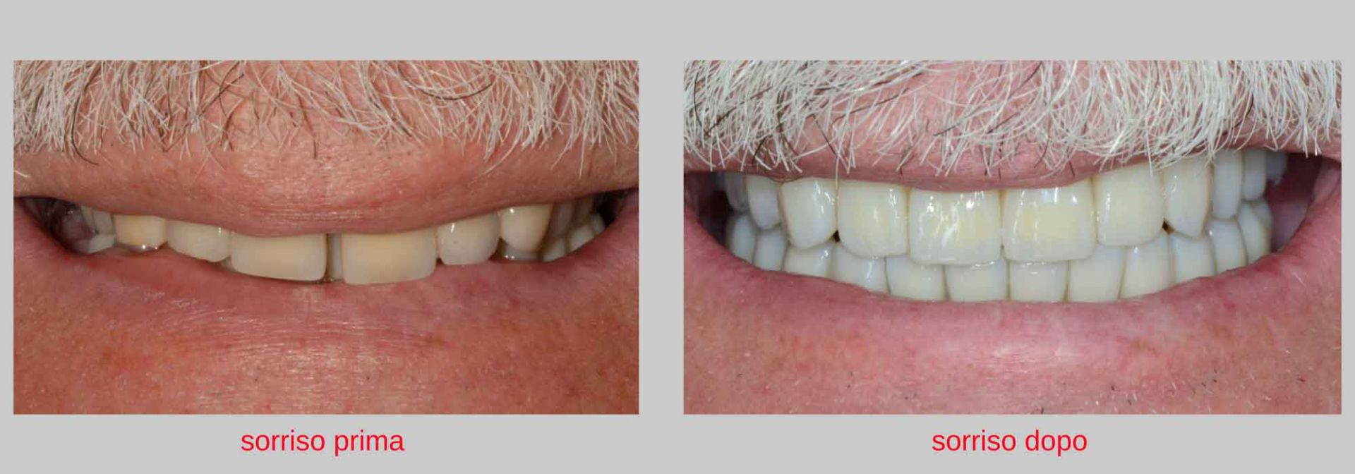 caso clinico implantologia estetica il sorriso