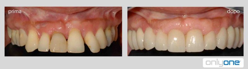 prima e dopo con protesi in zirconio