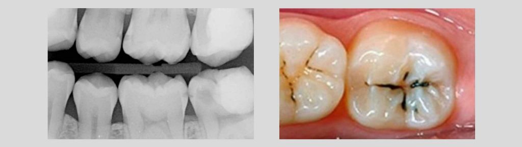 Radiografia b-wing e carie dei solchi occlusali