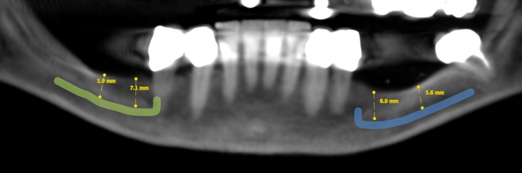 radiografia panoramica inferiore dopo la pianificazione implantologia computer guidata X-Guide