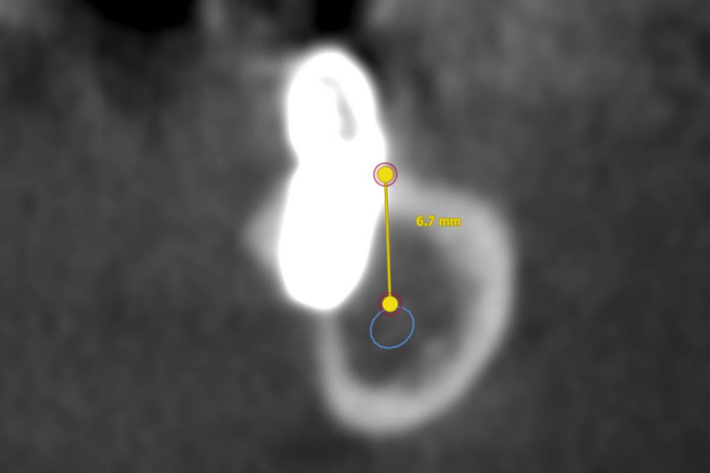 La tac di controllo dopo l'intervento che evidenzia l'impianto inclinato per evitare il nervo alveolare inferiore implantologia computer guidata X-Guide
