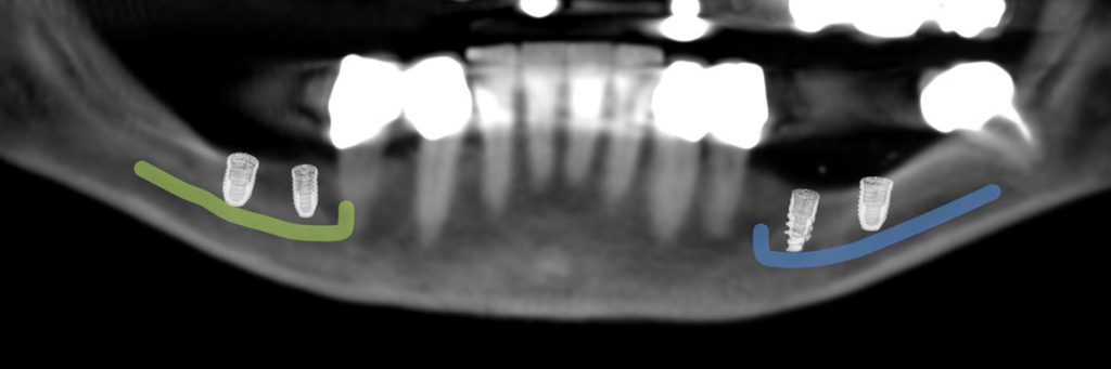 pianificazione chirurgica implantologia computer guidata X-Guide