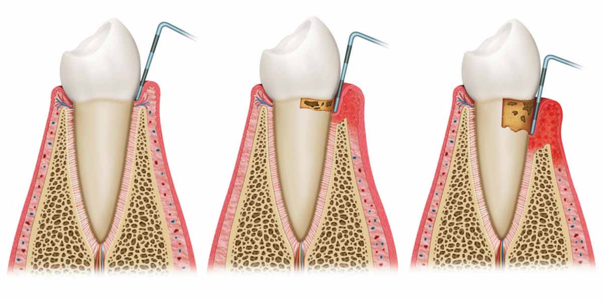 evoluzione della parodontite