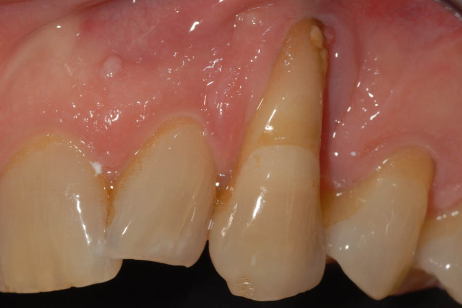 Recessione gengivale prima