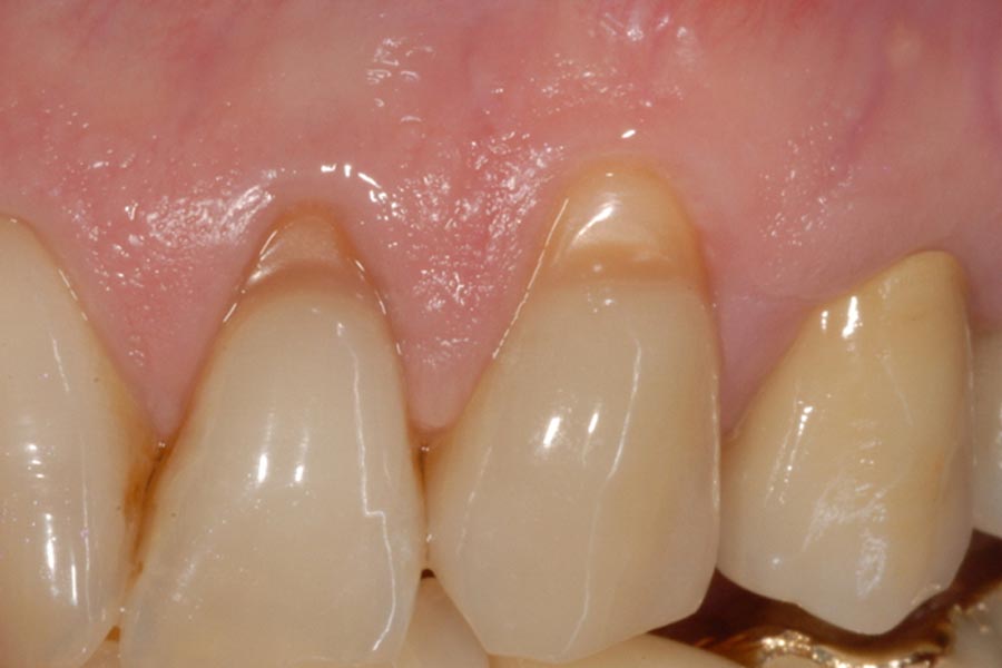 Recessione gengivale ed abrasione dei colletti dei denti