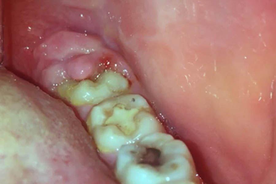 Pericoronite: infezione a livello della gengiva del dente del giudizio