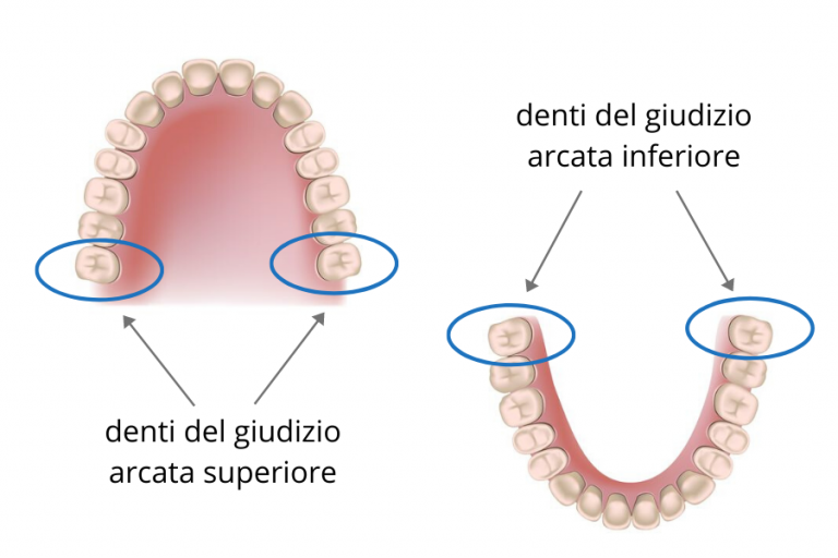 Dente Del Giudizio Nervo Trigemino Dente del giudizio: sintomi, cura e costi - Clinica Villa