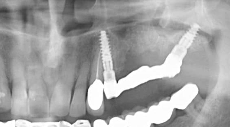 radiografia panoramica di un impianto pterigoideo