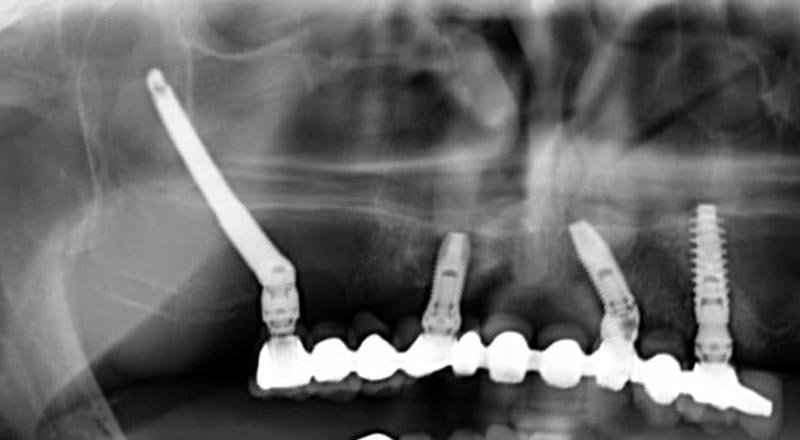 radiografia panoramica di un impianto zigomatico