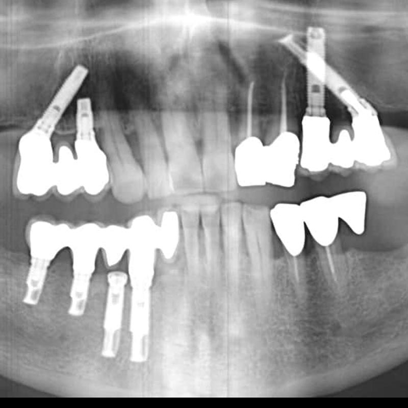 panoramica con impianti dentali inclinati