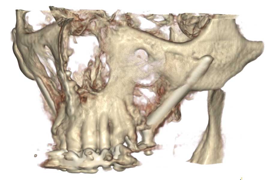 Ricostruzione tridimensionale della Tac dopo l'intervento. Visione laterale
