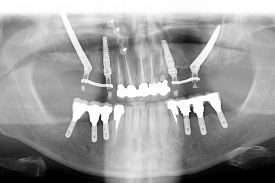 radiografia panoramica di impianti zigomatici