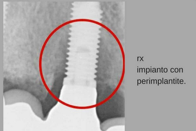 radiografia di un impianto con perimplantite 