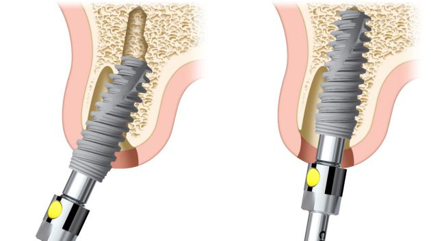 implantologia dentale intervento