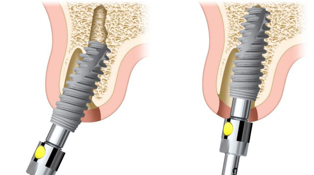 intervento di implantologia dentale 