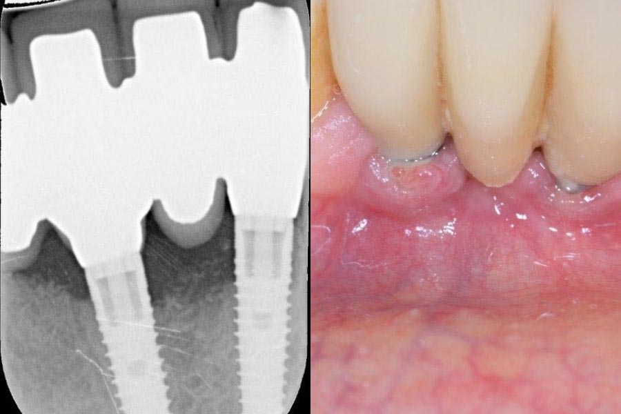 radiografia e foto di una perimplantite iniziale