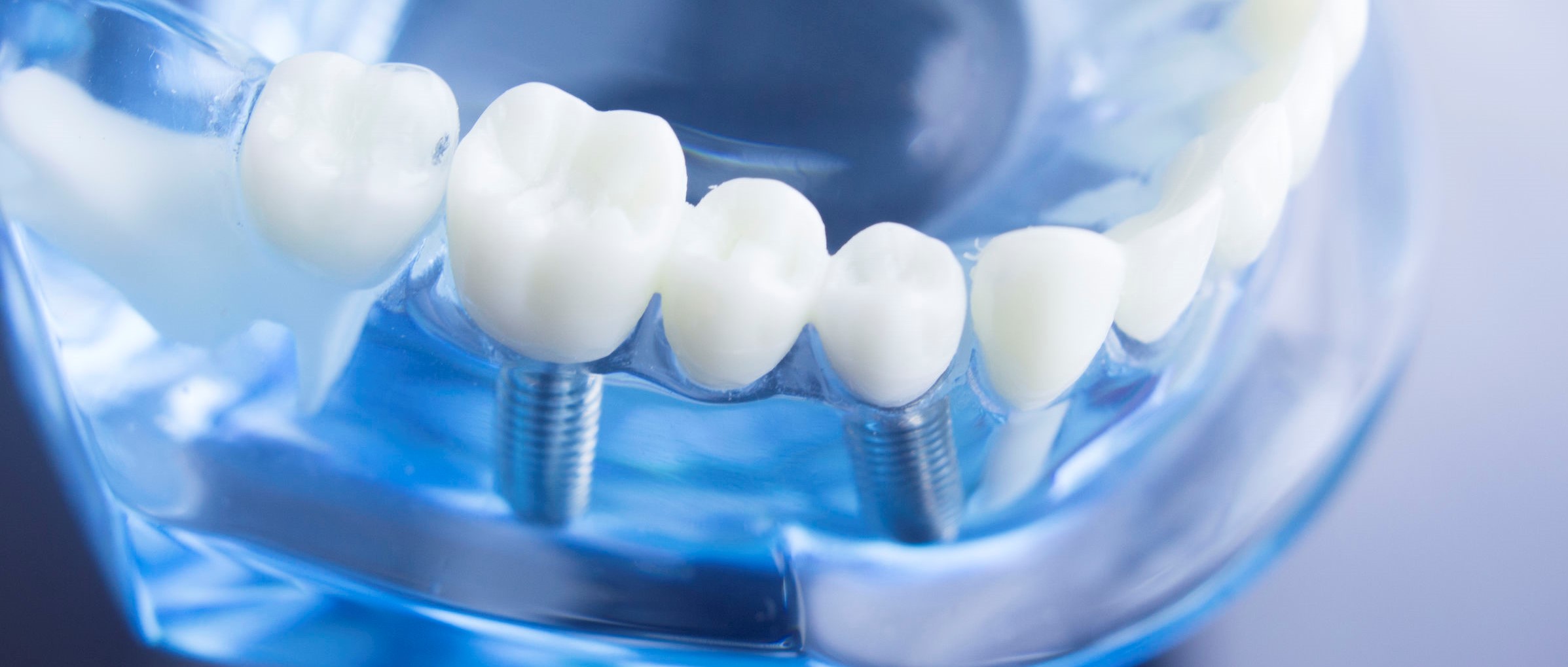 impianti dentali