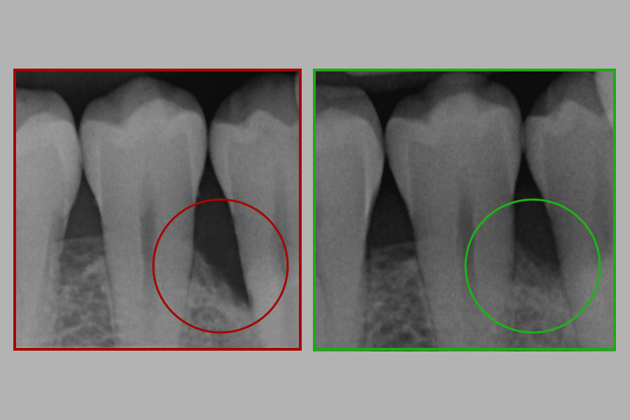 radiografia prima e dopo di un trattamento per la cura della parodontite