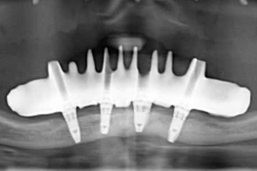 impianti dentali corti