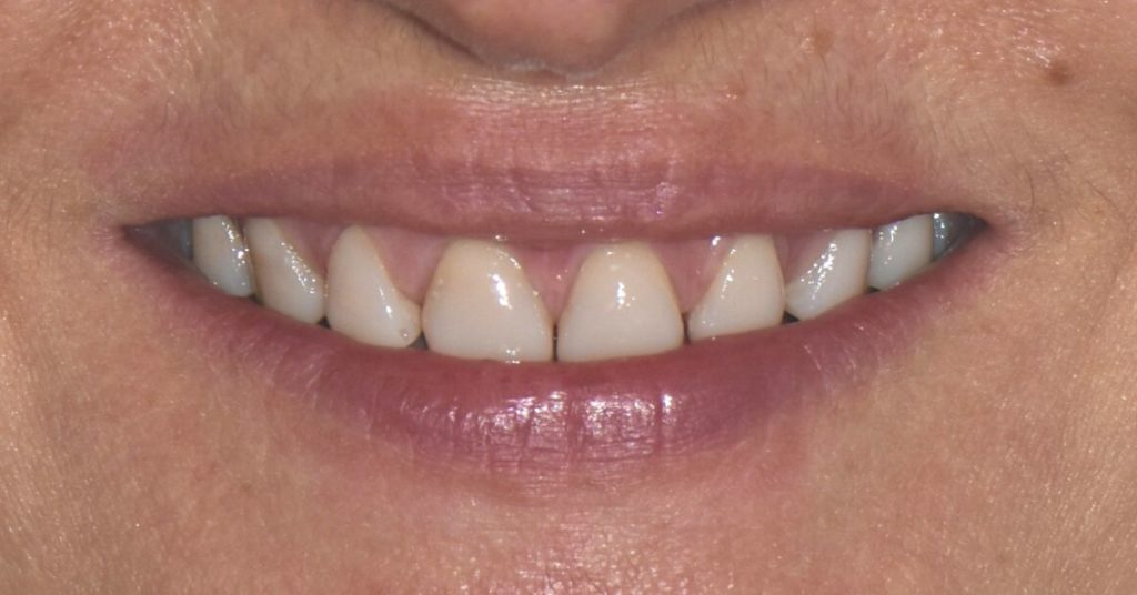 riabilitazione su denti naturali dopo