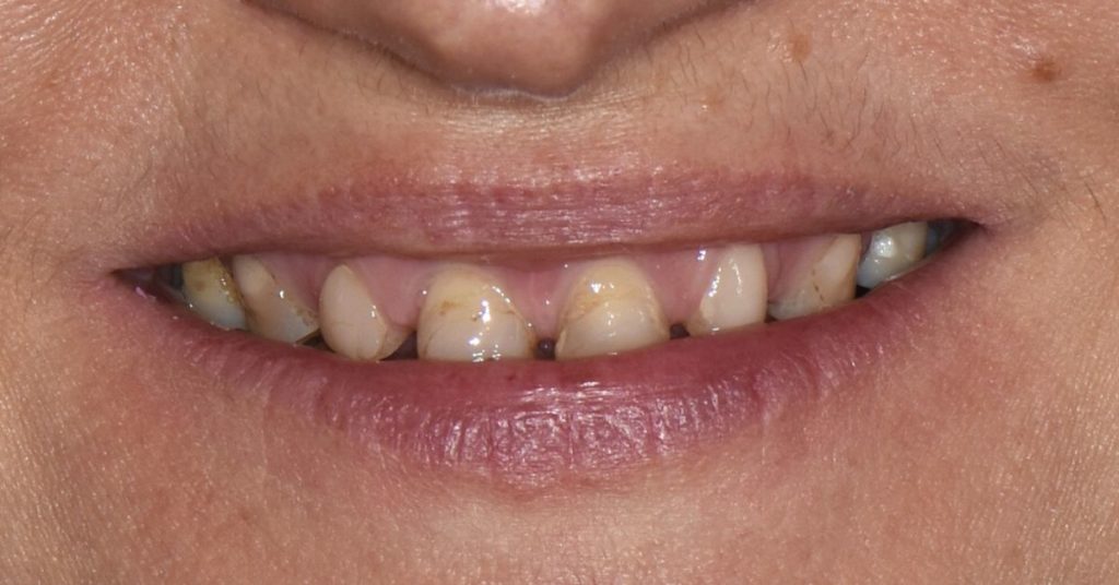 riabilitazione su denti naturali prima