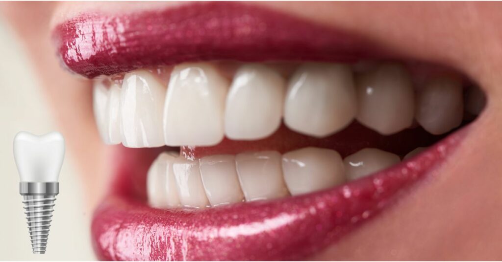 Cover implantologia dentale in aree estetiche