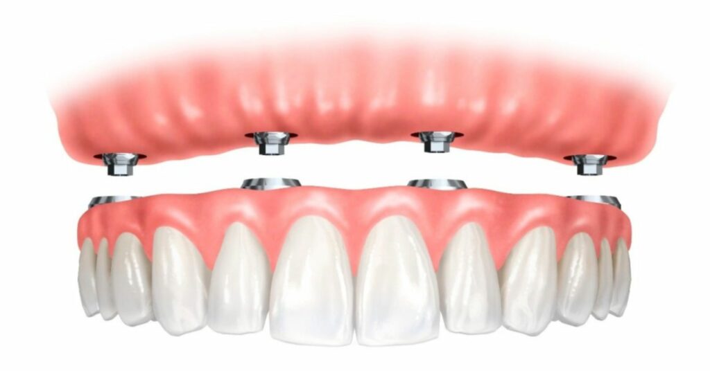 Cover Impianti Dentali con Gengiva Finta