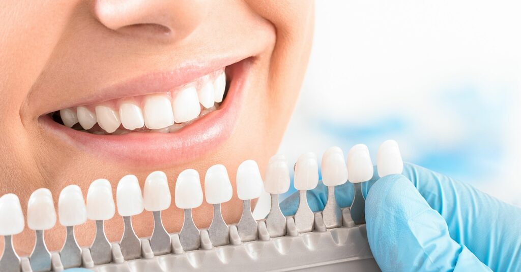 cover sbiancamento professionale