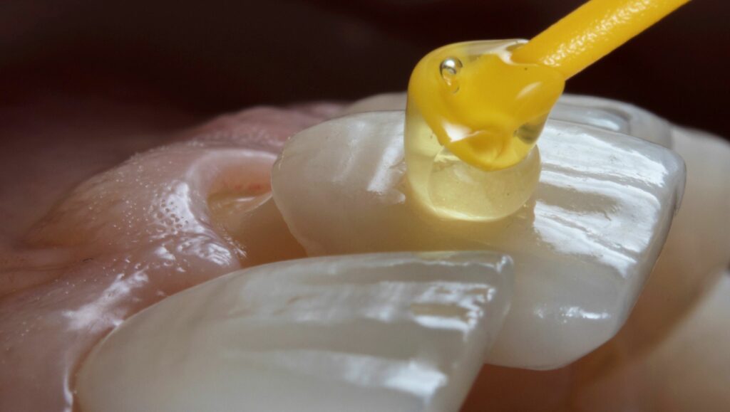 faccette dentali applicazione