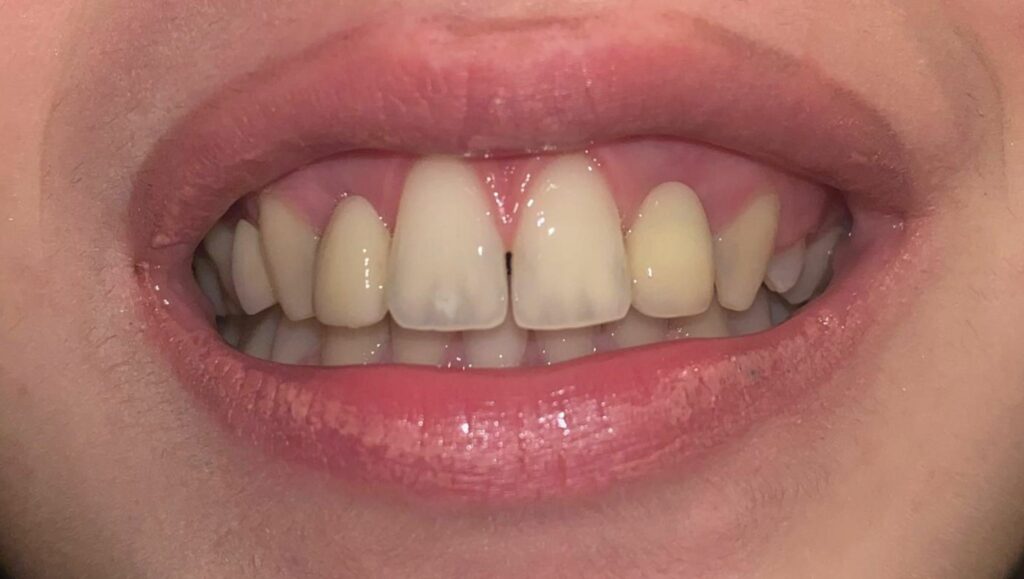 Caso clinico di Maryland dentale prima del trattamento