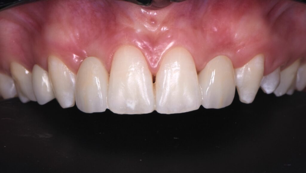 Caso clinico di Maryland dentale dopo il trattamento