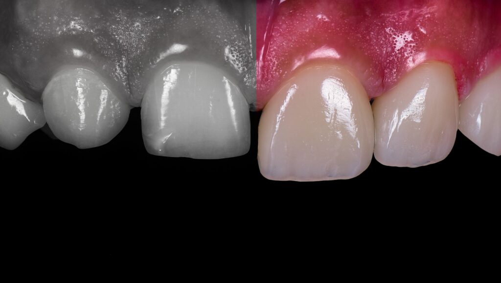 faccette dentali paragone