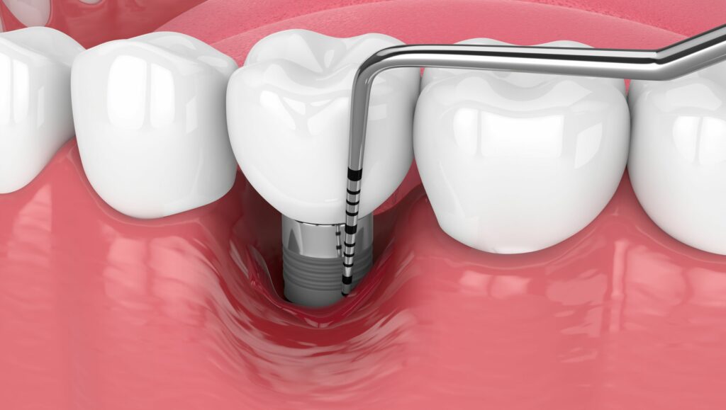 impianto dentale affetto da infezione e perdita ossea