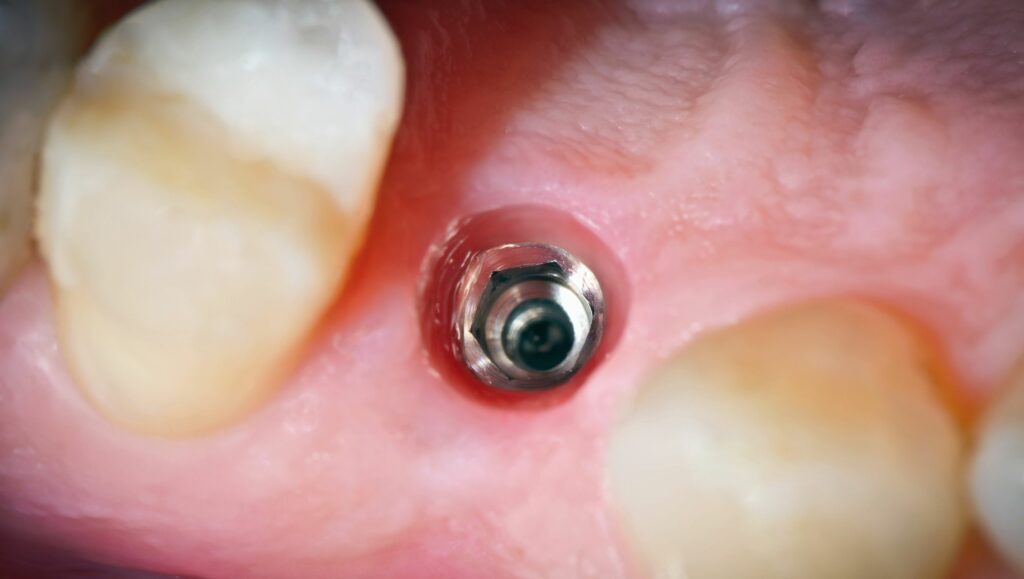 tessuto gengivale sano e spesso attorno all'impianto dentale