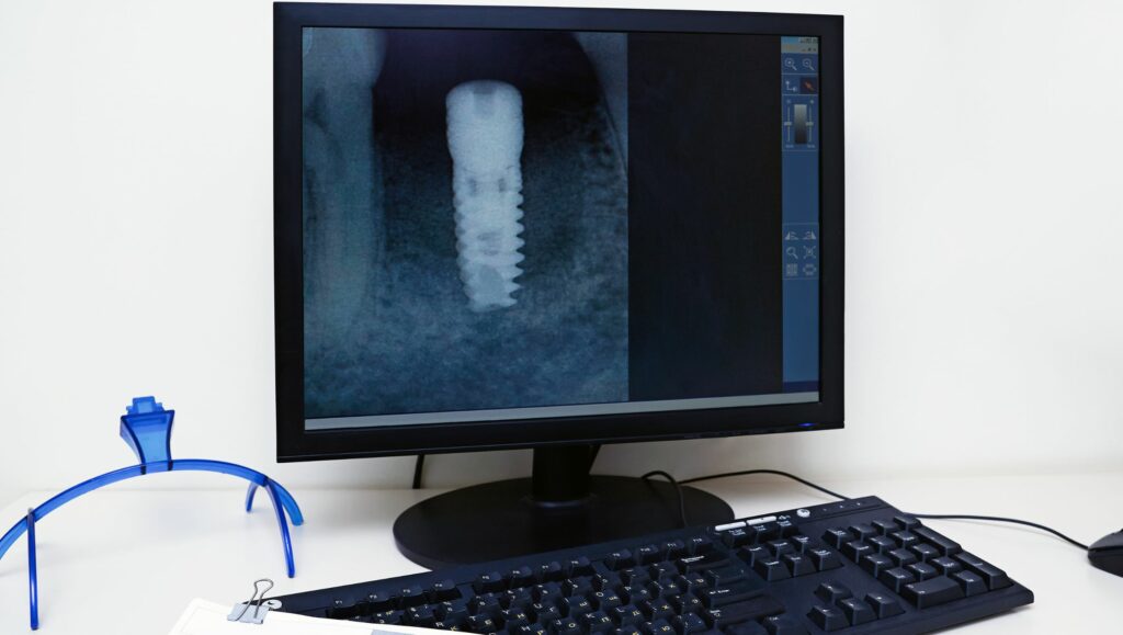 radiografia di un impianto dentale con perdita ossea estesa