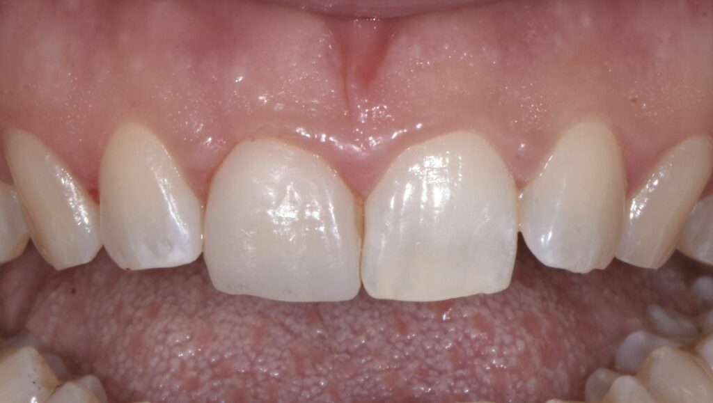 caso clinico dopo l'inserimento della faccetta dentale sull'incisivo centrale