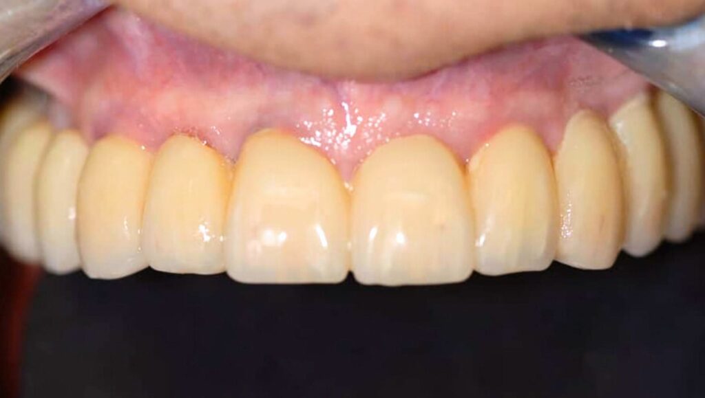 caso clinico risolto con ponte avvitato su impianti dentali