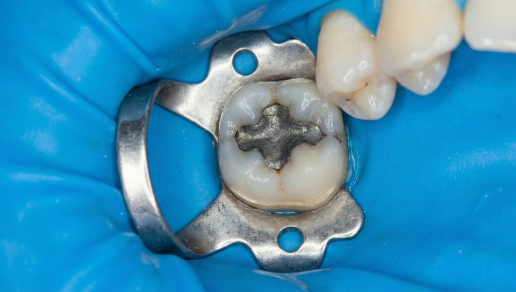 Fase operativa della rimozione protetta dell'amalgama sotto diga di gomma, utilizzando fresa con irrigazione e aspirazione ad alta velocità per eliminare polveri e vapori di mercurio