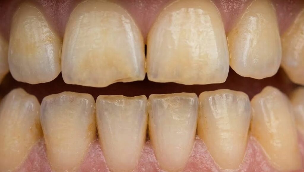 Macro fotografia che mostra l'usura dello smalto e piccole scheggiature sui denti inferiori.